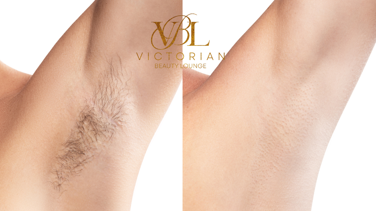Say Goodbye to Dark Underarms, Hair & Odor: Proven Treatments for Filipinas